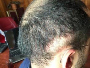 3650-grafts-hair-transplant (9)