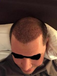 asmed-hair-transplant-results (15)