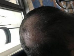 asmed-hair-transplant-results (20)