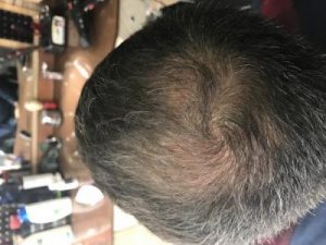 asmed-hair-transplant-results (22)