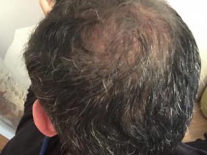 asmed-hair-transplant-results (28)