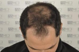 asmed-hair-transplant-results (5)