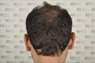 asmed-hair-transplant-results (6)