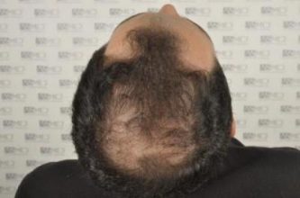 asmed-hair-transplant-results (7)