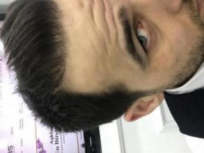 dr-kul-hair-transplant-result (1)