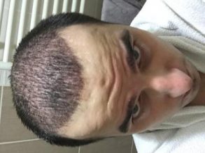 dr-kul-hair-transplant-result (10)