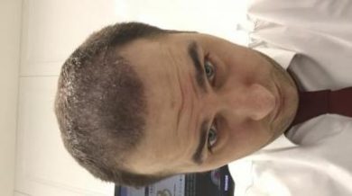 dr-kul-hair-transplant-result (11)