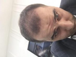 dr-kul-hair-transplant-result (12)