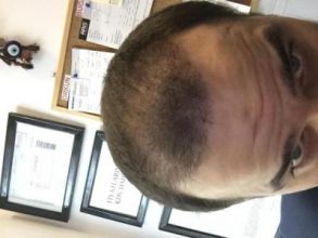 dr-kul-hair-transplant-result (13)