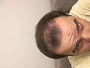 dr-kul-hair-transplant-result (14)