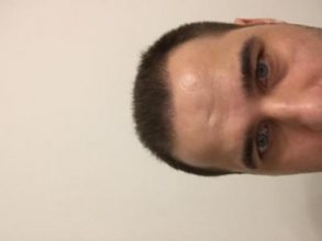 dr-kul-hair-transplant-result (15)