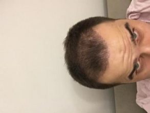 dr-kul-hair-transplant-result (16)