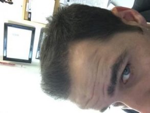 dr-kul-hair-transplant-result (18)