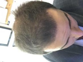 dr-kul-hair-transplant-result (19)