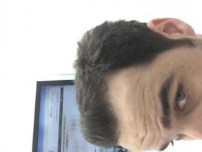 dr-kul-hair-transplant-result (21)