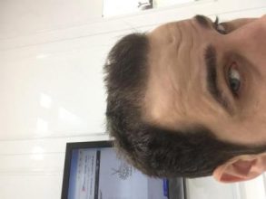 dr-kul-hair-transplant-result (22)