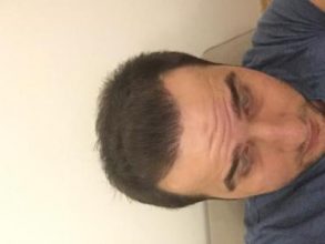 dr-kul-hair-transplant-result (23)