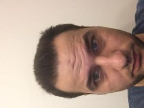 dr-kul-hair-transplant-result (24)