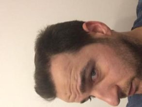 dr-kul-hair-transplant-result (25)