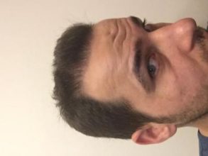 dr-kul-hair-transplant-result (26)