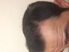 dr-kul-hair-transplant-result (27)