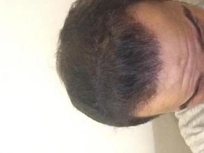 dr-kul-hair-transplant-result (29)