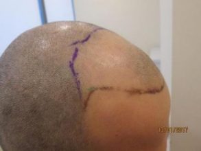 dr-kul-hair-transplant-result (3)