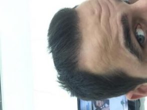 dr-kul-hair-transplant-result (31)