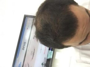 dr-kul-hair-transplant-result (32)