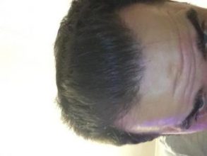 dr-kul-hair-transplant-result (34)