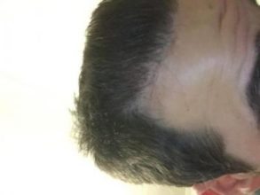 dr-kul-hair-transplant-result (36)