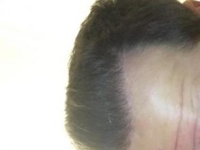 dr-kul-hair-transplant-result (37)