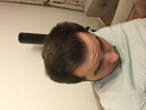 dr-kul-hair-transplant-result (38)