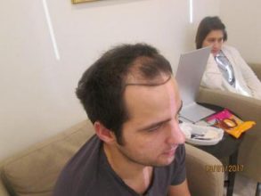 dr-kul-hair-transplant-result (4)