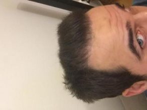 dr-kul-hair-transplant-result (40)