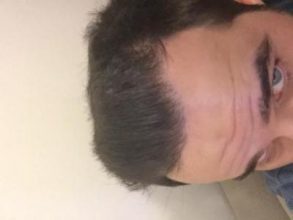 dr-kul-hair-transplant-result (41)