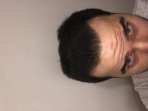 dr-kul-hair-transplant-result (42)