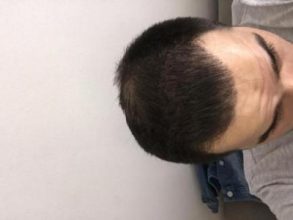 dr-kul-hair-transplant-result (43)