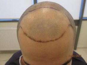 dr-kul-hair-transplant-result (5)