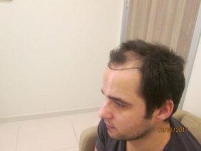 dr-kul-hair-transplant-result (6)