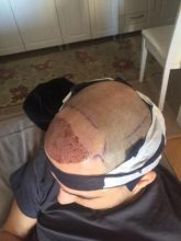 dr-kul-hair-transplant-result (7)