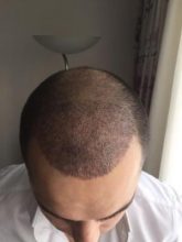 dr-kul-hair-transplant-result (8)