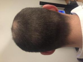 dr-kul-hair-transplant-result (9)
