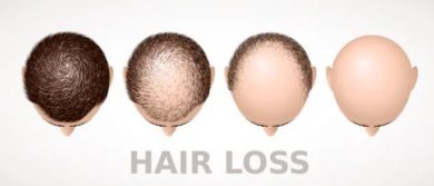 hair-loss-treatment