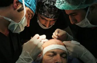 hair-transplant-process