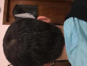 3200-grafts-fue (1)
