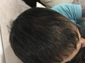 3200-grafts-fue (10)