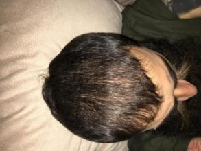 3200-grafts-fue (11)