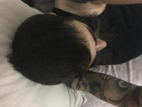 3200-grafts-fue (12)