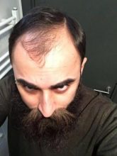 3200-grafts-fue (15)
